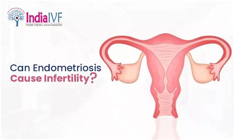 Endometriosis and Infertility: What You Need to Know
