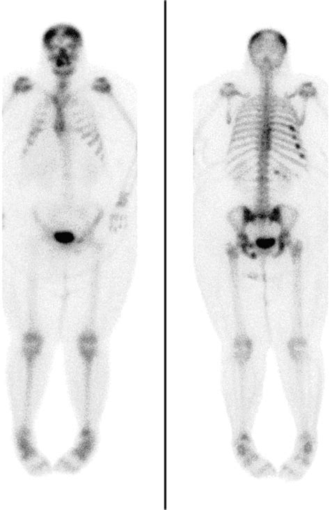 Impact of Obesity on Nuclear Medicine Imaging | Journal of Nuclear ...