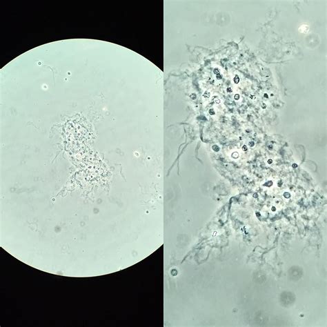 Urinalysis Mucus Rare at Ryan Strader blog