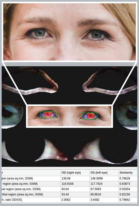 Image result for Eye Diseases Google Engineer Machine Learning