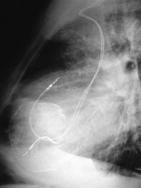 A Ring in the Heart Calcified Left Ventricular Aneurysm | Circulation