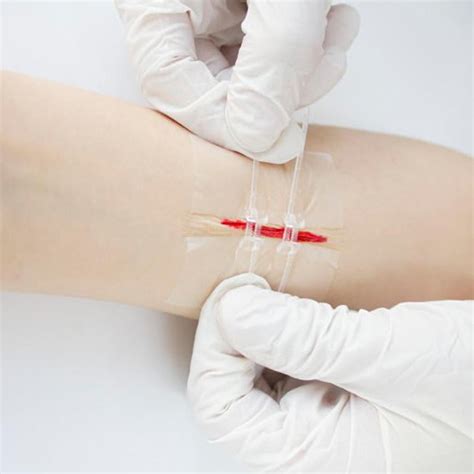 Buy Zip Stitch Sutures, Emergency Laceration Closures, Zipstitch ...