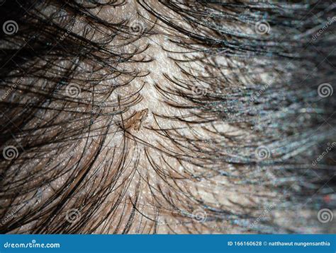 Louse Egg on the Hair Causes Itchy Head Stock Photo - Image of hair, medical: 166160628