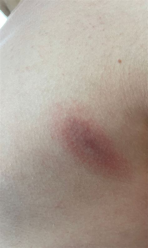Lyme rash? | BabyCenter