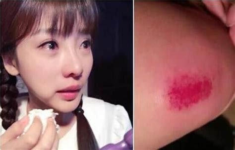 盘点十大美女惨不忍睹的受伤场面
