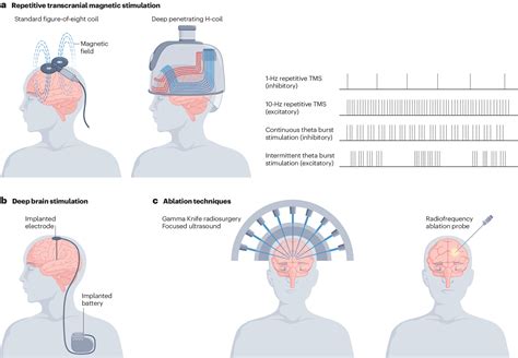 Examples of Focal Neurological Deficits and Their Implications