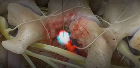 Image result for Selective Nerve Root Block