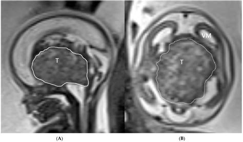 Fetal Brain Tumors, a Challenge in Prenatal Diagnosis, Counselling, and Therapy