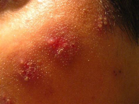 Adults re-exposed to chickenpox are less likely to get shingles