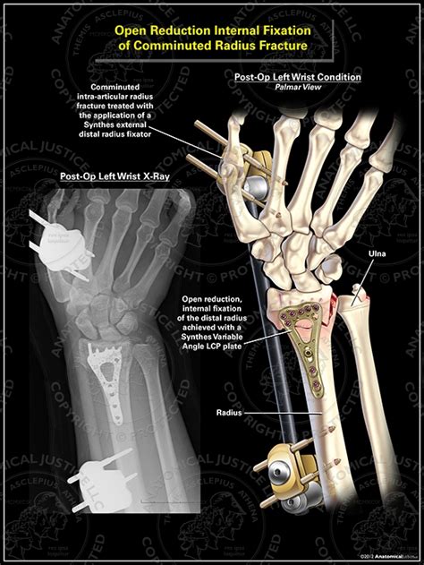 Image result for Open Reduction Distal Radius Fracture
