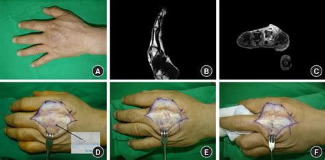 Image result for Extensor Digitorum Communis Surgery