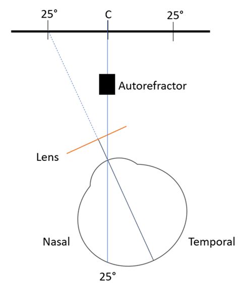 Peripheral Refraction and Visual Function of Novel Perifocal Ophthalmic ...