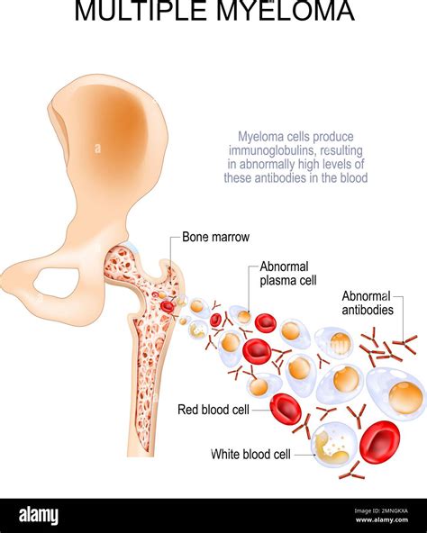 Multiple myeloma. Myeloma cells in Bone marrow produce immunoglobulins, resulting in abnormally ...