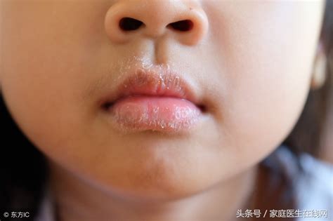 唇炎怎么治？治疗唇炎常用这14种方法！ - 知乎