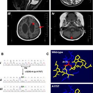 Image result for Pyruvate Dehydrogenase Complex PDHA1
