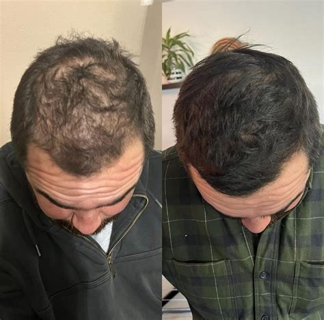 How Effective is Finasteride? Benefits, Pros & Cons, Results - Finasteride