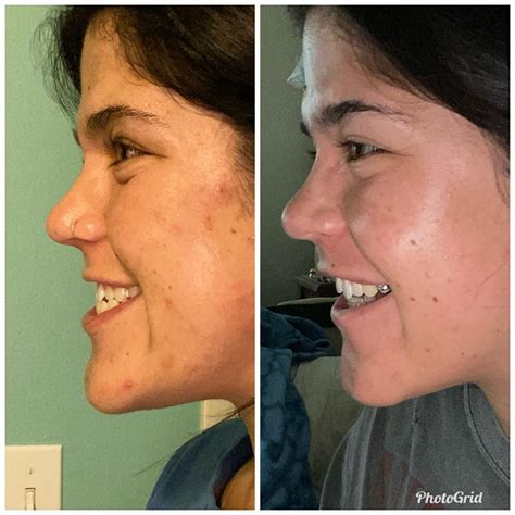 Face Change Sarpe Surgery