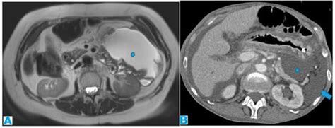 Unravelling Peritoneal Carcinomatosis Using Cross-Sectional Imaging ...