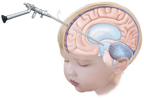 Endoscopic Brain Surgery Cyst at Imelda Metzger blog