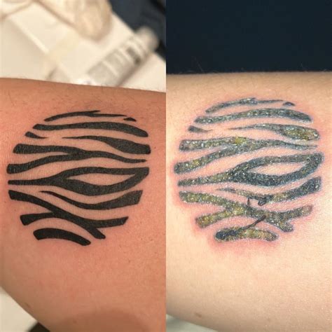 Infected Tattoo Before And After Sudbury Far From Being Infected