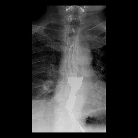 Esophageal Stricture Barium Swallow