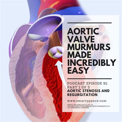 Podcast Episode 91: Cardiac Murmurs Made Easy Part 1 of 5 - Aortic Stenosis and Regurgitation ...