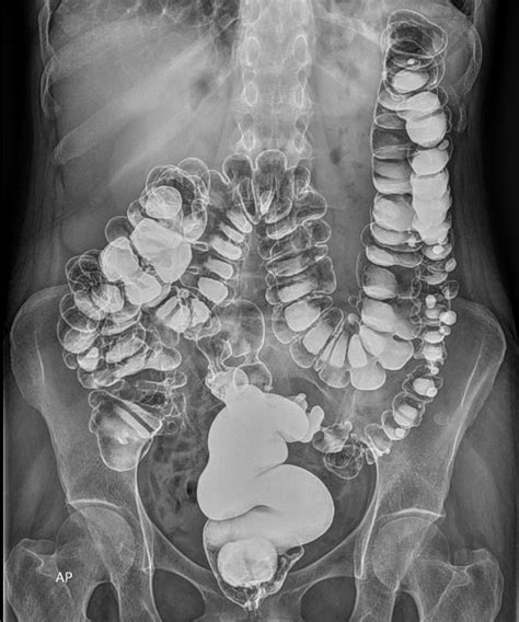 enema for diverticulitis