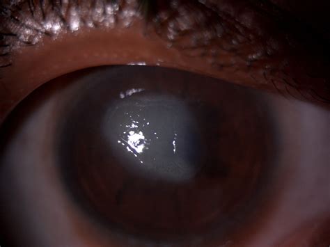 Vernal Keratoconjunctivitis | Treatment & Management | Point of Care