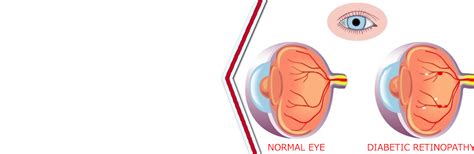 What is diabetic retinopathy? | Dr. Manisha Agarwal