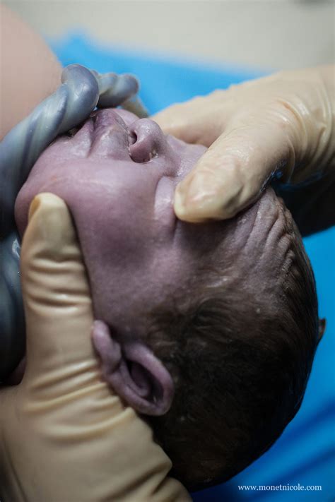 Bildergebnis für umbilical cord around neck complications