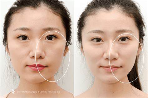 Asian Facial Contouring Photo Gallery | 77 Plastic Surgery in San Francisco