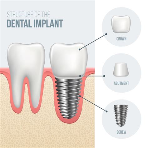 Dental Crowns Manhattan | Implant-Supported Bridge Services