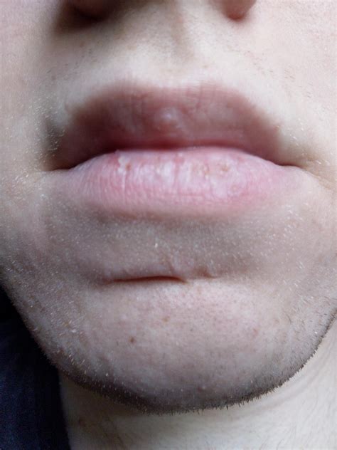 Baby Lips Dry And Peeling at Hamish Payne blog