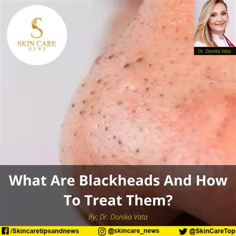 What Are Blackheads And How To Treat Them?