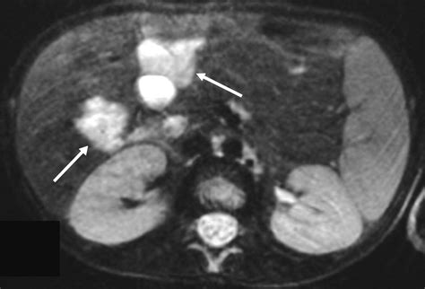 Imaging Characteristics of Blue Rubber Bleb Nevus Syndrome | AJR