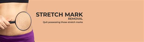 Laser Stretch Mark Removal Treatment in Bangalore, Hyderabad, Chennai