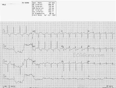 Wandering Baseline Ecg