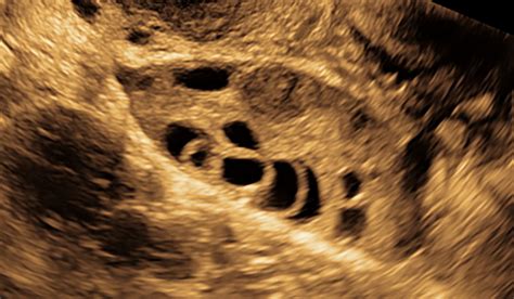 Normal and Abnormal Appearances of the Ovaries during Assisted ...