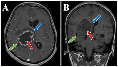 High-Grade Thalamic Glioma: Case Report with Literature Review