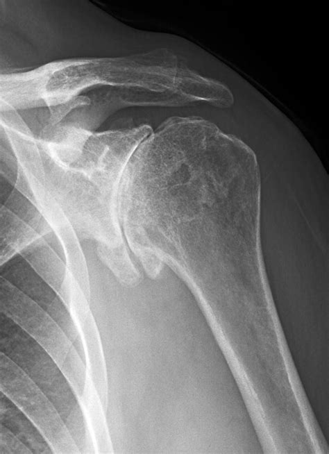 UW Shoulder and Elbow Academy: How bad is the shoulder arthritis on x-ray?