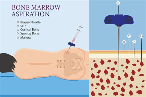 Bone Marrow Testing 的图像结果