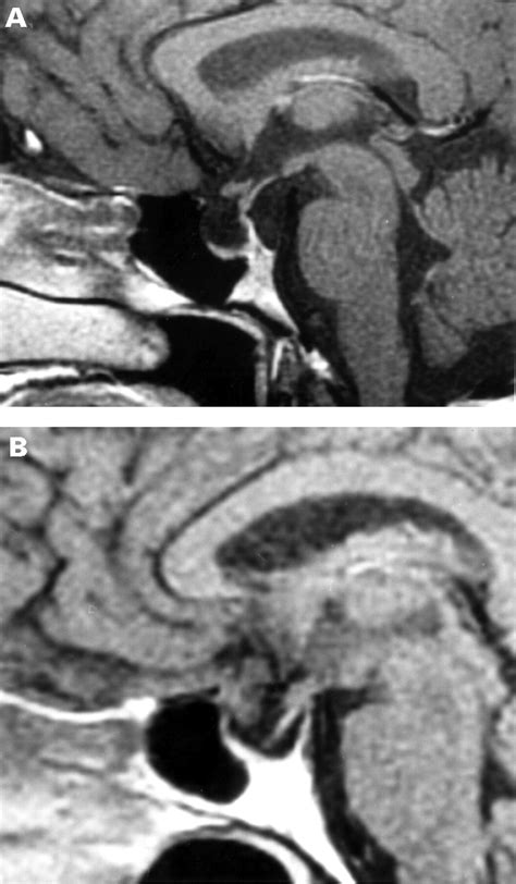 Neurology of the pituitary gland | Journal of Neurology, Neurosurgery & Psychiatry