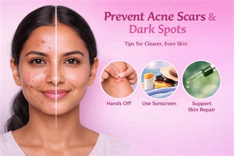 Acne Types Causes and Treatments Guide – Dr. Su