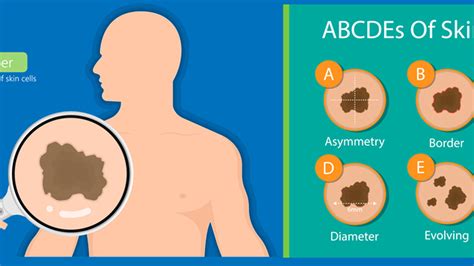 Early Signs Of Skin Cancer And Guide To Prevention | OnlyMyHealth