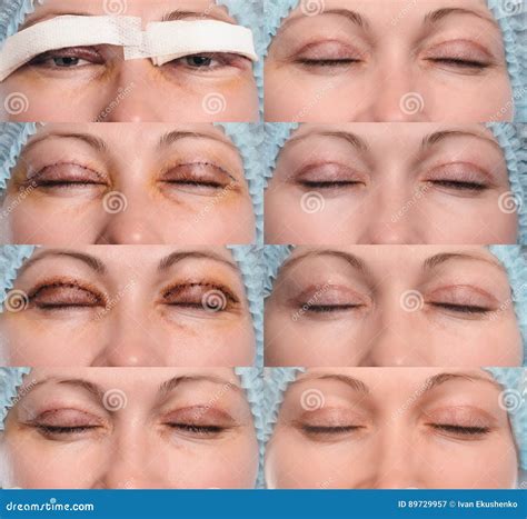 Blepharoplasty of the Upper Eyelid. Stock Image - Image of close, care: 89729957