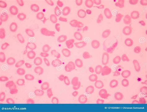 Thalassemia Blood Smear Abnormal Red Blood Cells Morphology. Stock ...