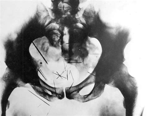 X-Ray of serial killer Albert Fish’s pelvis. Taken in 1935 after his ...