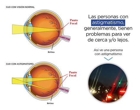 Astigmatismo Que Es