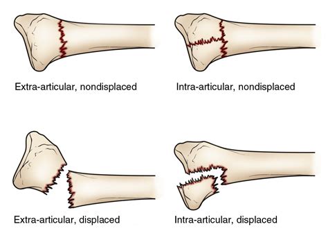 Image result for Distal Radius Fracture Recovery