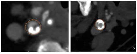 Patient Selection Criteria and Procedural Standardization for Carotid ...